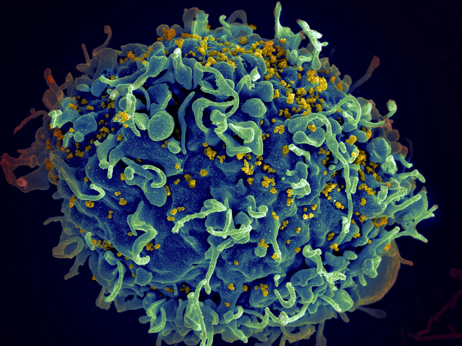 Colorized electron micrograph of a human T cell in blue with many small HIV particles in yellow attached to its surface
